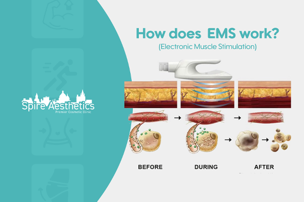 EMS treatment for post pregnancy weight loss treatment Uxbridge