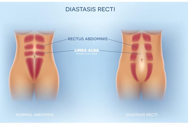 What Non-Surgical Options Are Available for Diastasis Recti Uxbridge?