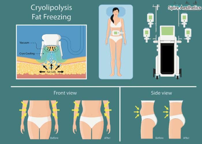 Image of diet and fat freezing combined for best results for Spire Aesthetics Uxbridge