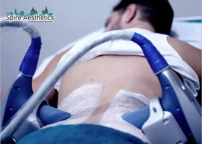 Man having fat freezing treatment done on love handles before a competitions Uxbridge to create a sculpted look.