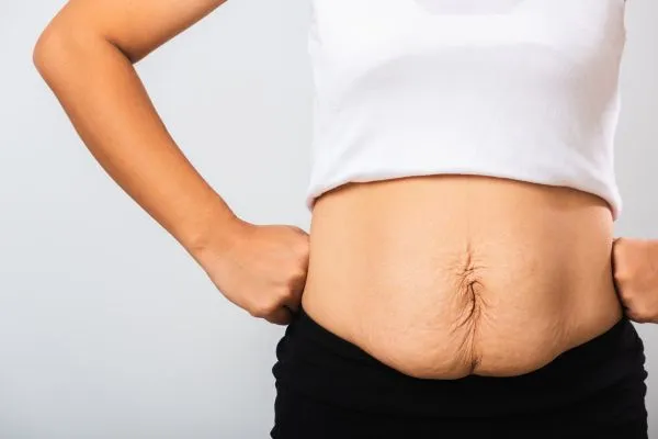 Image of a woman's stomach after weight loss with sagging skin following a gastric band Uxbridge