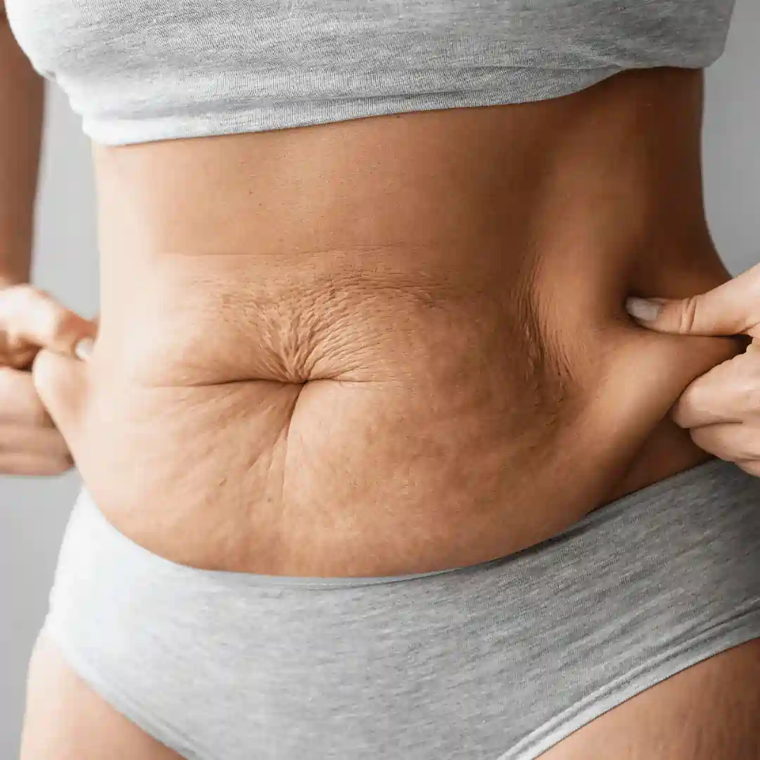 Is It Normal to Have Loose Skin After Pregnancy Uxbridge?