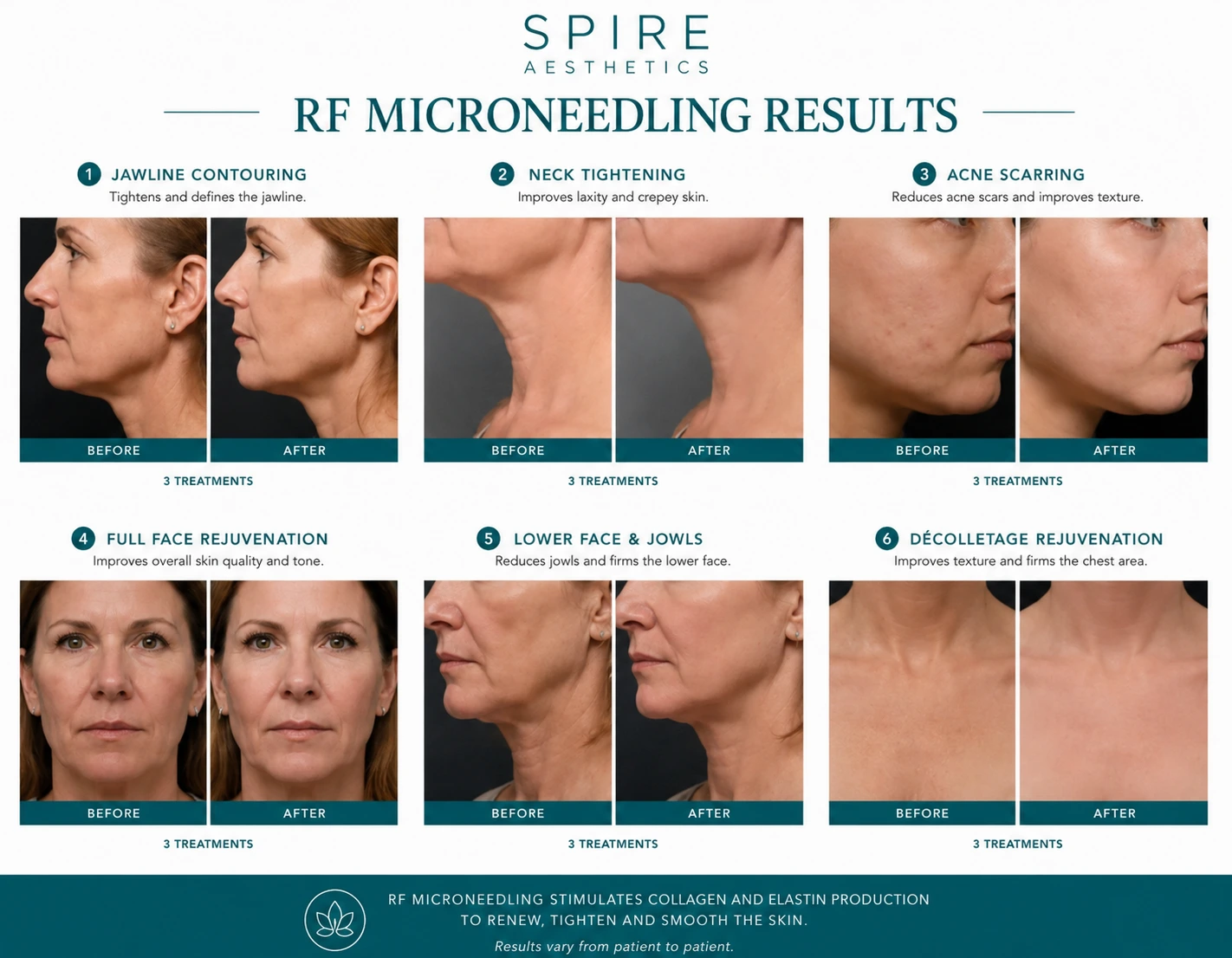 RF Microneedling Skin tightening Uxbridge results