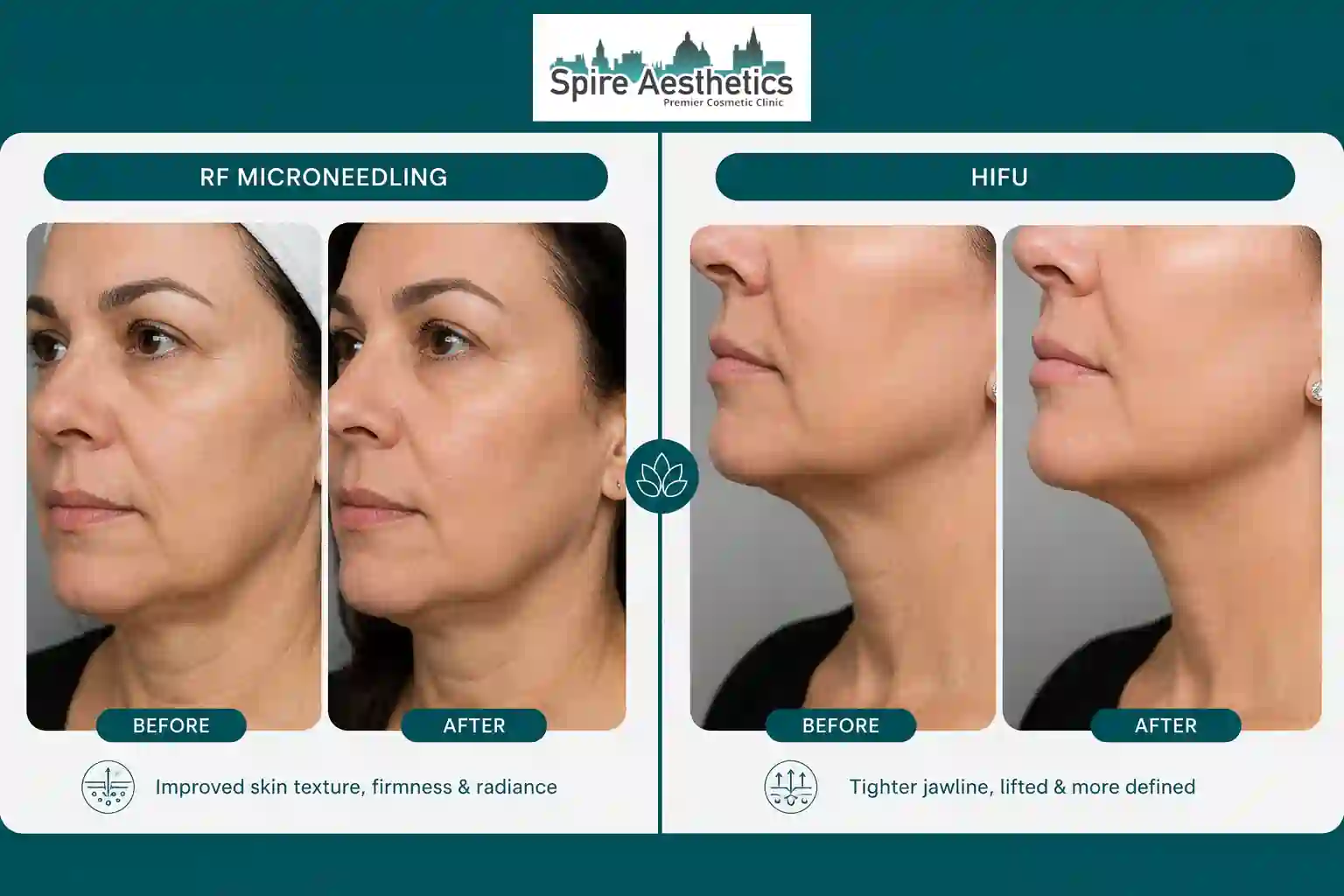 Can RF Microneedling and HIFU Be Combined Uxbridge?