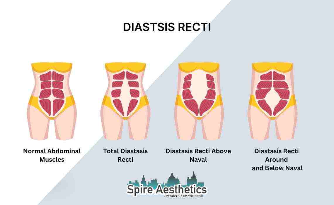 Is Non-Surgical Diastasis Recti Treatment Right for You? Common Concerns Answered Uxbridge